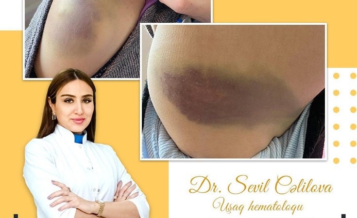 İdeopatik trombositopenik purpura (İTP) xəstəliyi nədir?